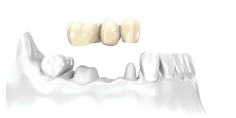 Prosthodontic Treatments at PERFECT SMILE